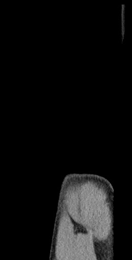 Schwarze und weiße MRI-Aufnahme eines Patientenknies, die detaillierte Knieanatomie zeigt.